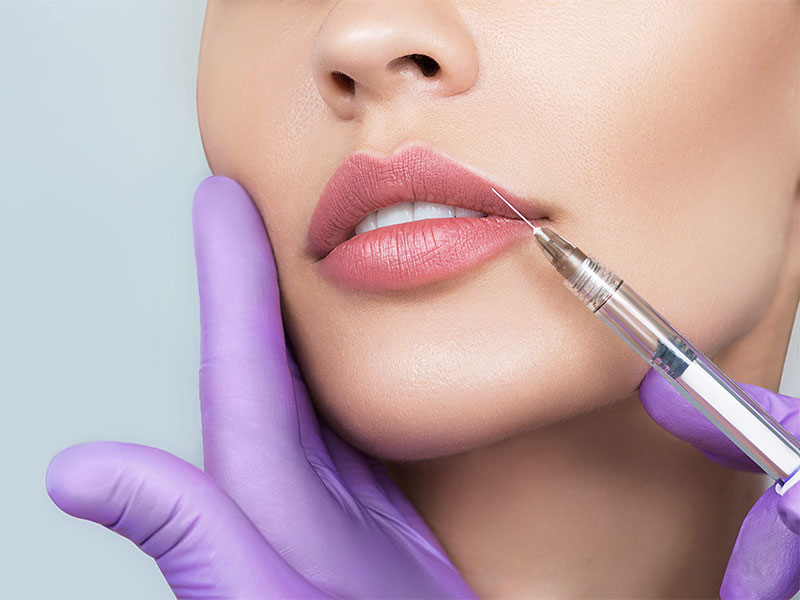 Filler labbra