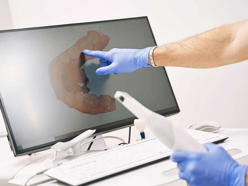 Scanner intraorale