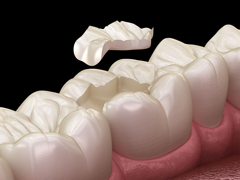 Intarsi dentali