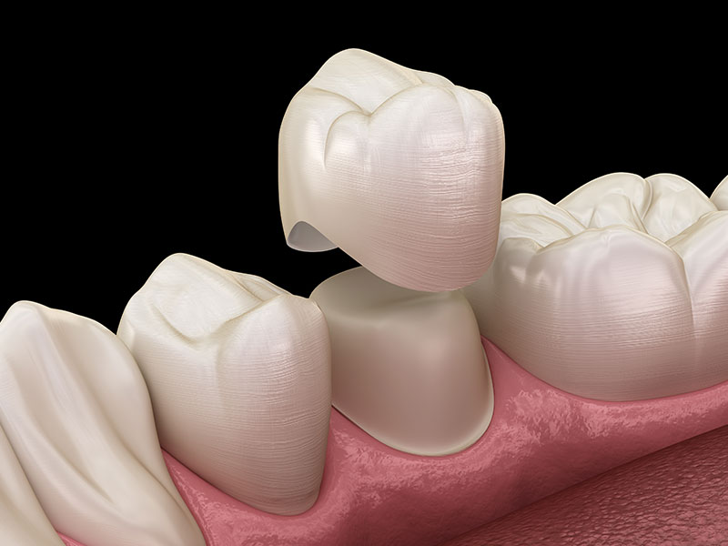 Corone dentali