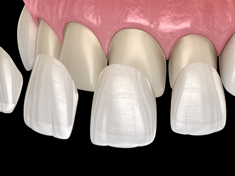 Faccette dentali
