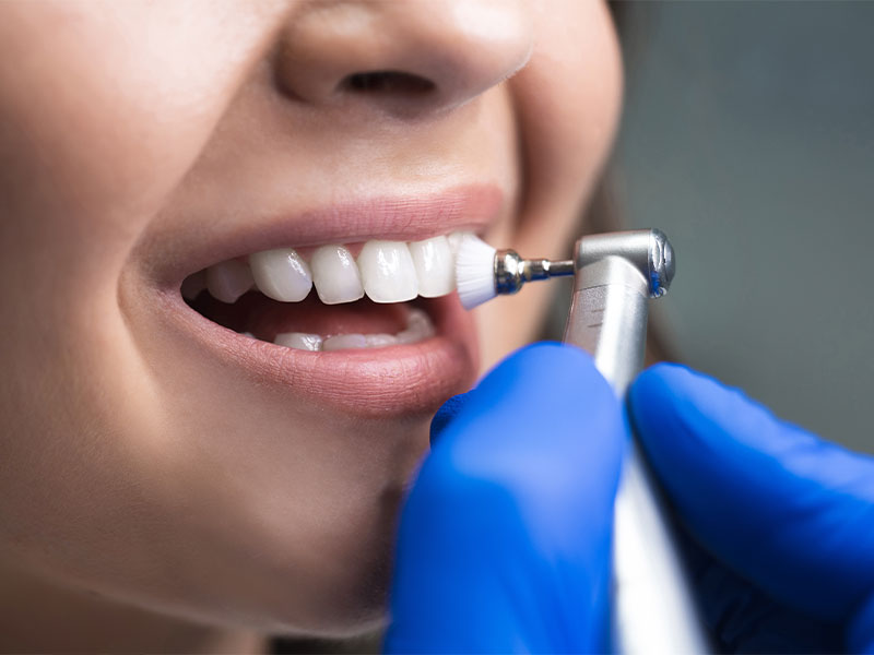Sbiancamento dentale